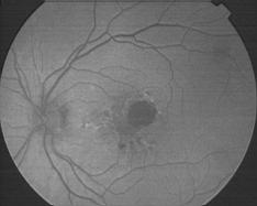 autofluorescence par angiographe TRC.50IX
