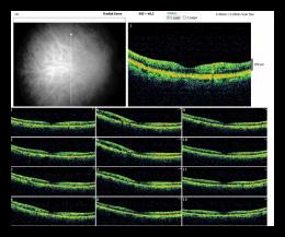 RADIAL LINE OD