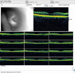 RADIAL LINES OD