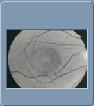 CRSC atypique - an�rythre